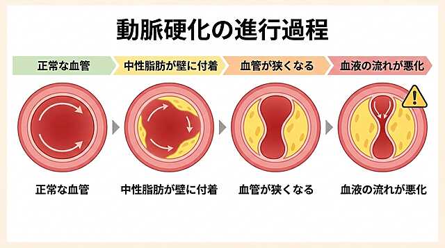 動脈硬化の進行過程